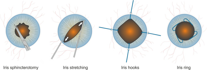 Exploring the impact of pupil expansion techniques on cataract surgery: unveiling key complications and clinical outcomes: a comparative analysis of 1266 eyes.