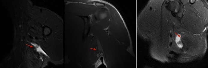 <i>Latissimus Dorsi</i> Tendon Repair Through Single-Incision Axillary Approach Using All-Suture Anchor Tension Slide.