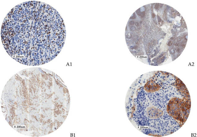 Immunohistochemical profiling of Bcl-2 and EGFR proteins in cervical carcinoma at a tertiary hospital in Ghana.