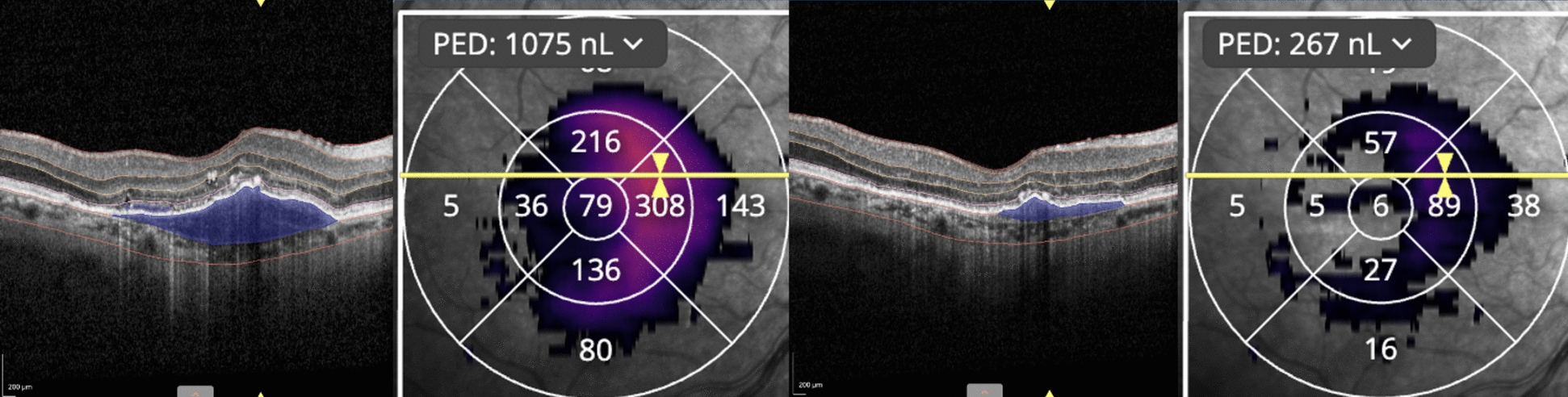 Faricimab for treatment-resistant choroidal neovascularization (CNV) in neovascular age-related macular degeneration (nAMD): seven-months results using artificial intelligence and OCTA.