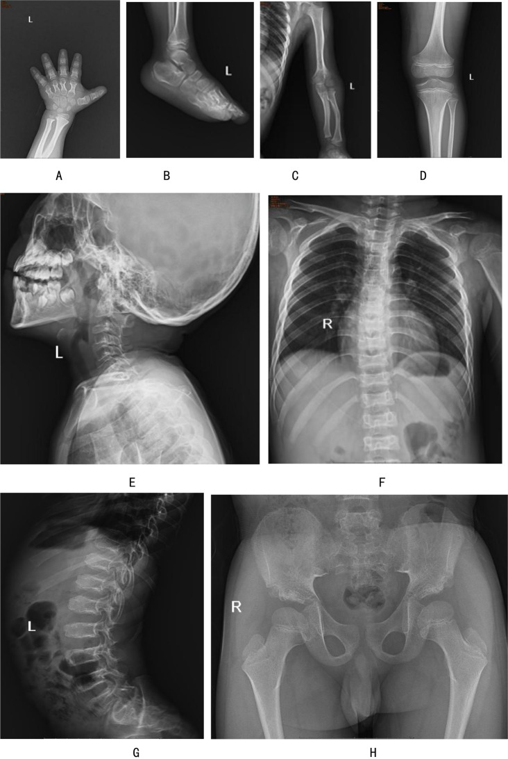 A novel variant in NPR2: C.2291T > C (p.Leu764Pro) identified in a patient with acromesomelic dysplasia Maroteaux type.