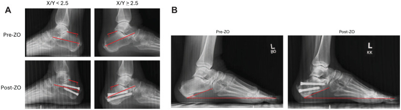 The Effect of Preoperative X/Y Ratio on Clinical Outcomes following Percutaneous Zadek Osteotomy for Insertional Achilles Tendinopathy.
