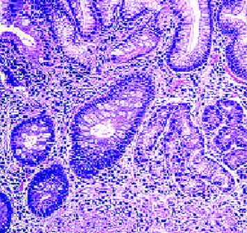 Behçet's Disease and Autoimmune Atrophic Gastritis: An Incidental Finding.