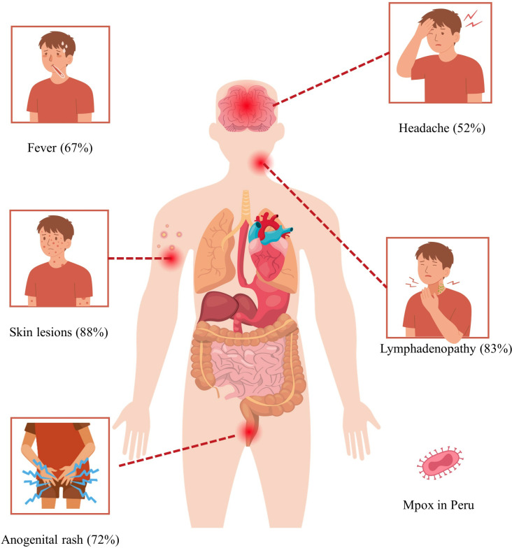 Epidemiological and clinical characteristics of Peruvian patients with mpox: A systematic review and meta-analysis.