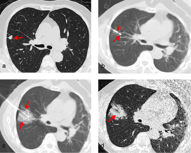 Efficacy and safety in synchronous core-needle biopsy and cryoablation for highly suspicious malignant pulmonary nodule.