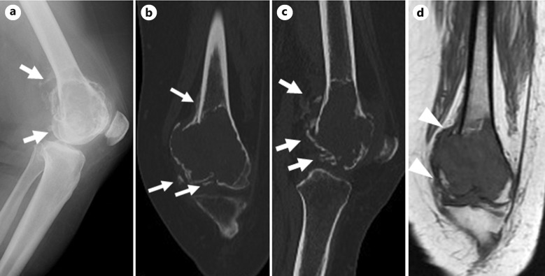 Beta-Catenin Positive Giant Cell Tumor of Bone with Pathological Fracture Treated with Neoadjuvant Denosumab Therapy for Visualizing Extraskeletal Lesions.