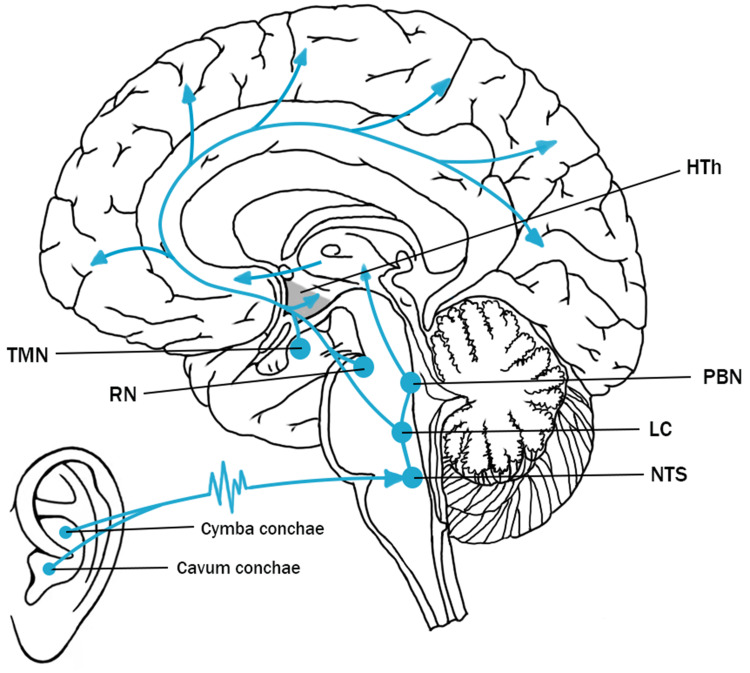 Transcutaneous Auricular Vagus Nerve Stimulation (taVNS) for Insomnia Disorder: A Narrative Review of Effectiveness, Mechanisms and Recommendations for Clinical Practice.