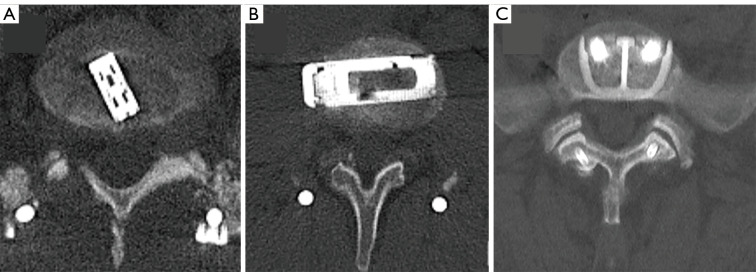 The evolving role of lateral lumbar interbody fusion in lumbar fusion: challenging the dominance of transforaminal interbody fusion.