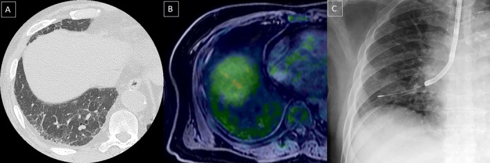 Pulmonary Intravascular Large B-Cell Lymphoma Diagnosed by Transbronchial Lung Cryobiopsy: A Case Report.