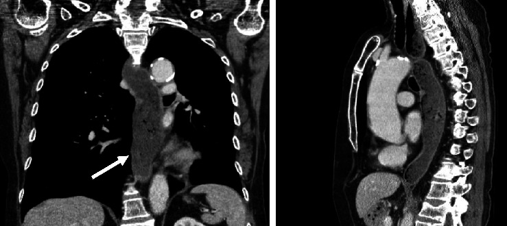 Late Onset of Pseudoachalasia in Anti-Hu-Associated Syndrome.
