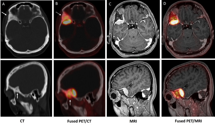 Molecular Perspectives on Meningioma with Osseous Infiltration Revealed by <sup>68</sup>Ga-DOTA TOC PET-CT.