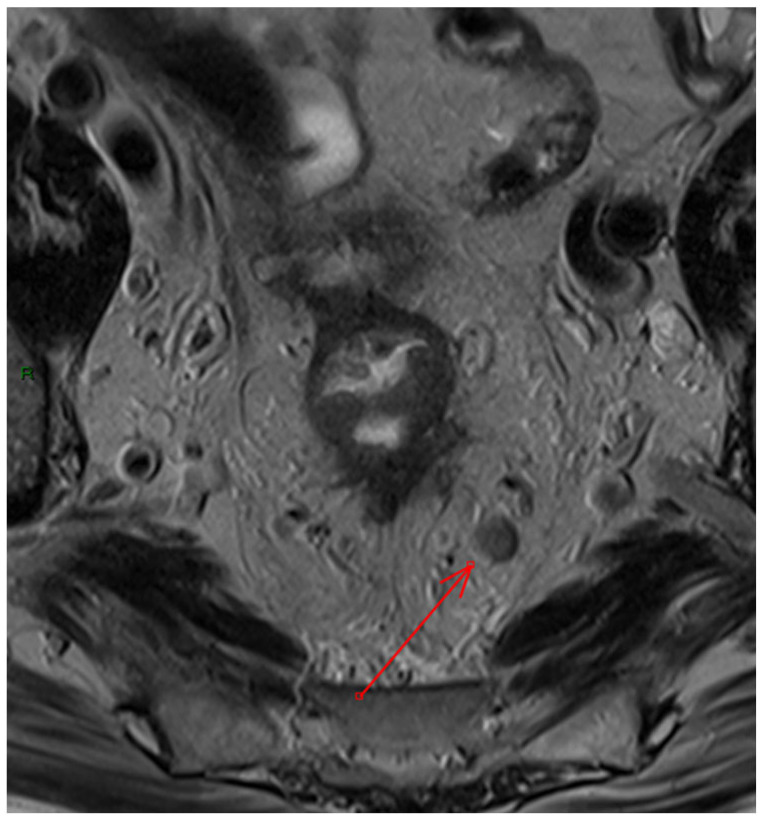 Predictive Utility of Structured MRI Reporting for Rectal Cancer Outcomes.