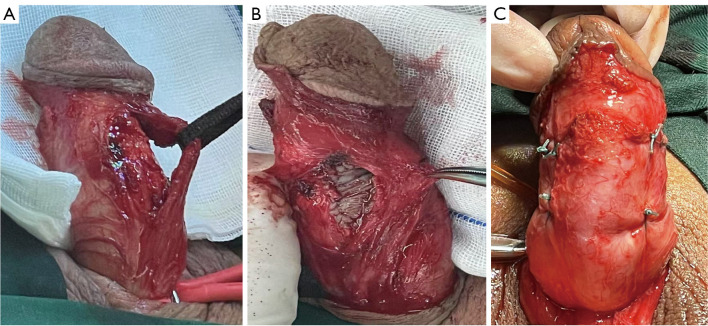 A novel autologous material for the surgical treatment of Peyronie's disease: the outer plate of the prepuce.