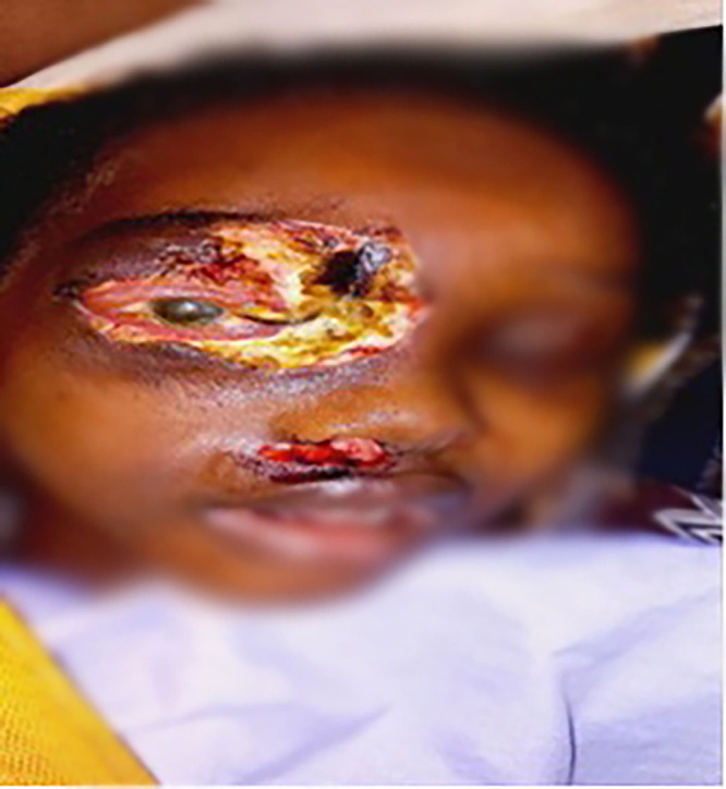 A Rare Battle: Multidisciplinary Care for a Child with Rhino-Orbital Cerebral Mucormycosis in Somali Region of Ethiopia.