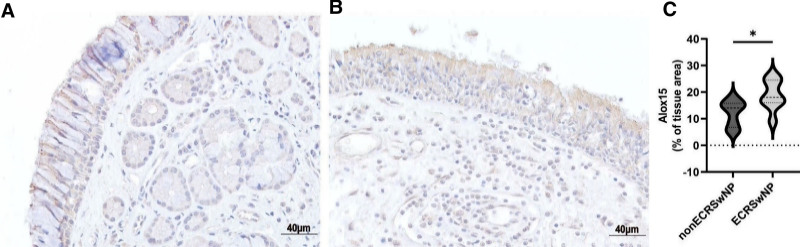 Predictive significance of 15(S)-hydroxyeicosatetraenoic acid for eosinophilic chronic rhinosinusitis with nasal polyps.