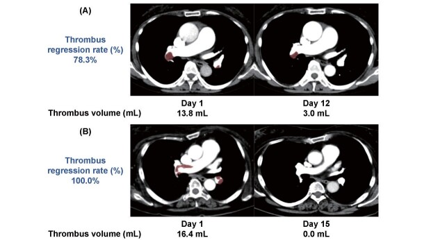 Clinical Significance of Early Computed Tomography Scan on Thrombus Regression Rate in Acute Pulmonary Embolism: Insights from the SAKURA PE/DVT REGISTRY.