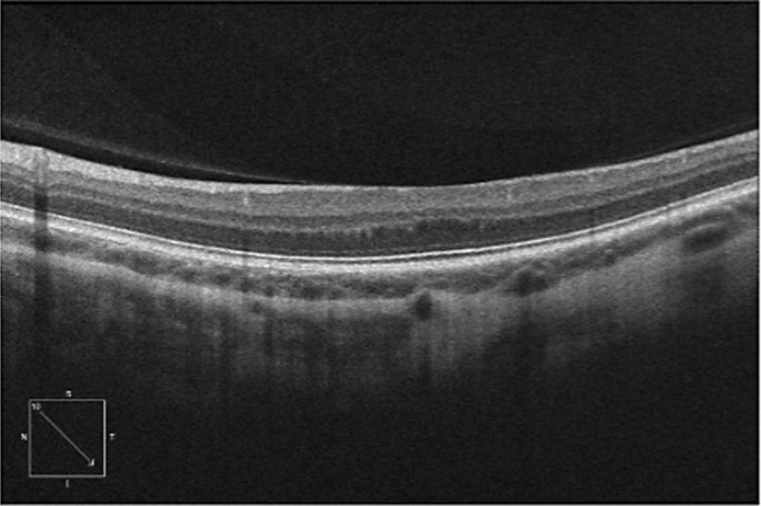 A Case of Epiretinal Membrane Masquerading as Foveal Hypoplasia Uncovered by Optical Coherence Tomography Angiography.