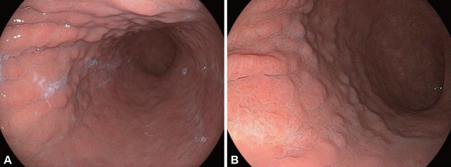 Autoimmune Gastritis: Unveiling the Mystery.