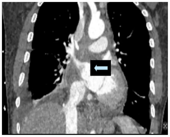 Metastatic Cardiac Angiosarcoma Presenting as Superior Vena Cava Syndrome and Cardiac Tamponade.