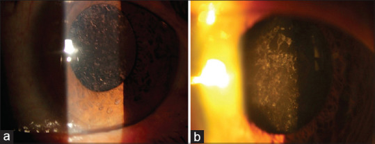 Effect of <i>Ginkgo biloba</i> extracts in the prevention of posterior capsule opacification after cataract surgery: A randomized clinical trial.