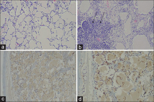 Isolated conjunctival lymphangioma.