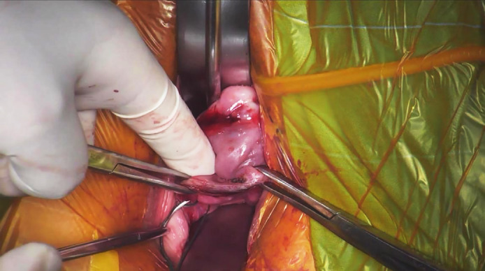 The presacral-uterosacral hysteropexy - a novel native tissue repair for pelvic organ prolapse.