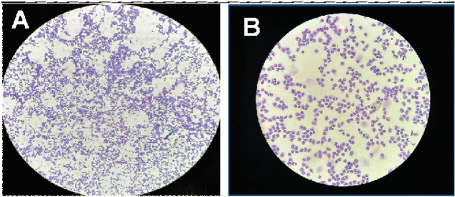 Diagnosis of a secondary central nervous system Lymphoma (SCNSL) in a patient with low proliferative Mantle cell lymphoma.