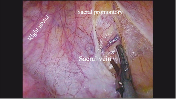 The presacral-uterosacral hysteropexy - a novel native tissue repair for pelvic organ prolapse.