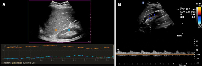 Role of sonographic hepatorenal index and renal resistive index in monitoring of acute kidney injury after liver transplantation.