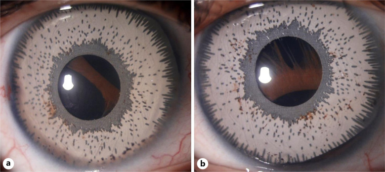 Neovascular Proliferation over a Cosmetic Artificial Iris Implant.