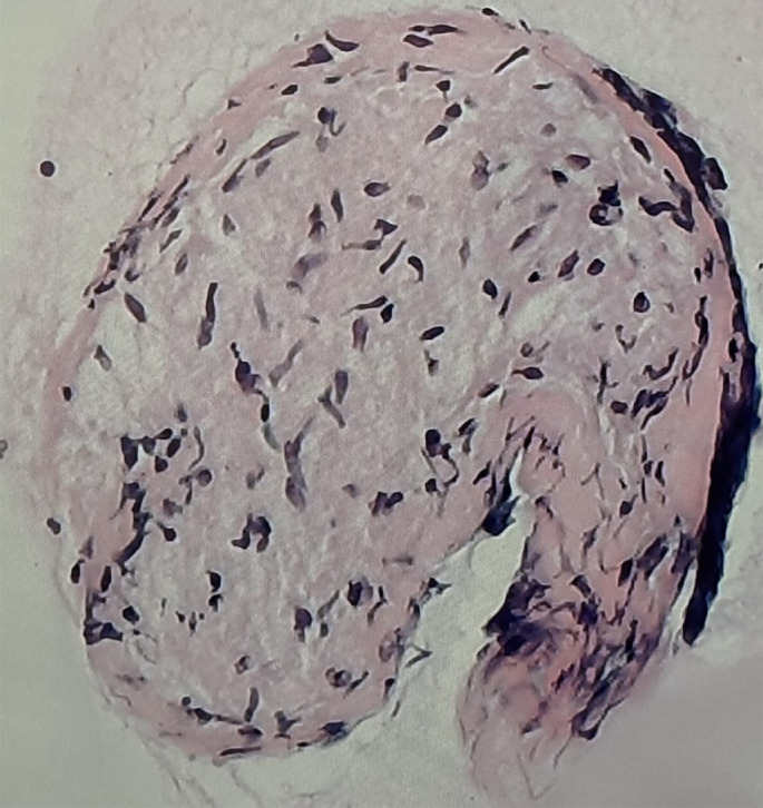 An unprecedented pathology in a 20-year-old with progressive dyspnoea and parenchymal infiltrates.