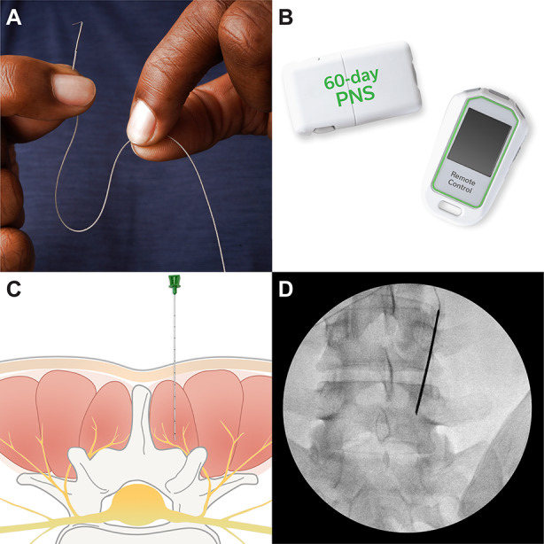 Four-Year Follow-Up from a Prospective, Multicenter Study of Percutaneous 60-Day Peripheral Nerve Stimulation for Chronic Low Back Pain.