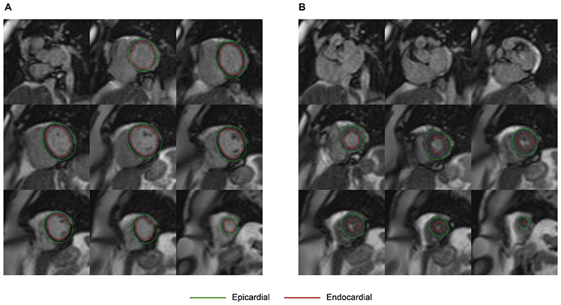 Establishing Cardiac MRI Reference Ranges Stratified by Sex and Age for Cardiovascular Function during Exercise.