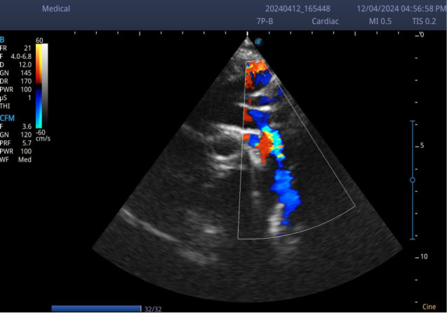 Coarctation of the Aorta Presenting as Haemorrhagic Stroke in a 3-Year-Old Boy- A Case Report.