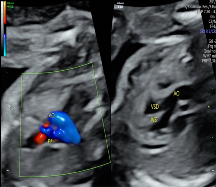 Compound Heterozygous Loss-of-Function Variants in CCM2L in a Fetus With Tetralogy of Fallot.