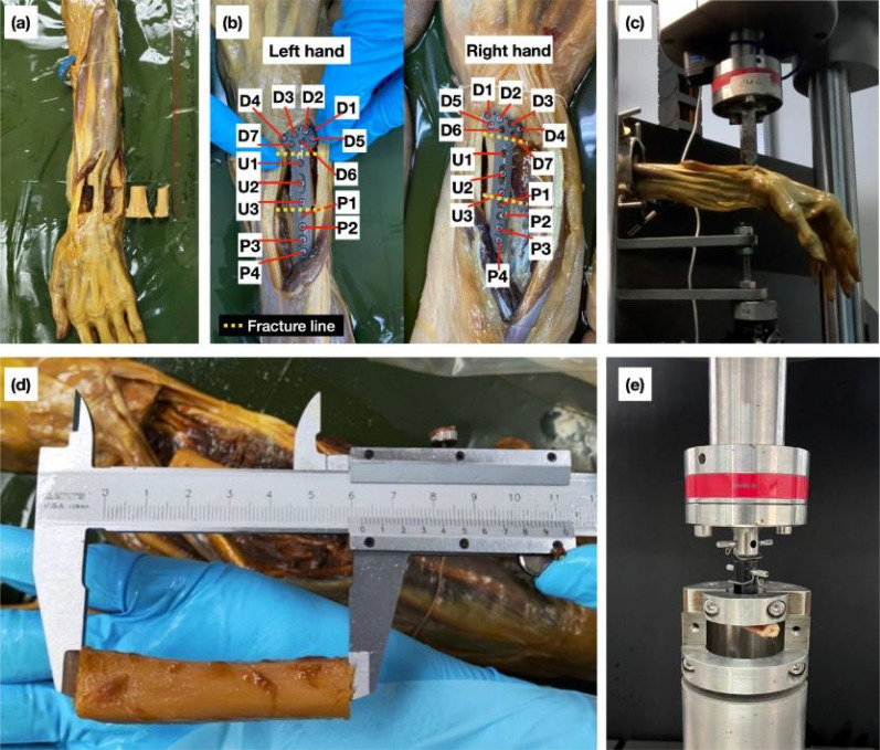 Evaluation of screw pull-out from plate fixation of en bloc distal radius resection with ulnar reconstruction: Finite element analysis and comparison with experiments on Thiel cadavers.