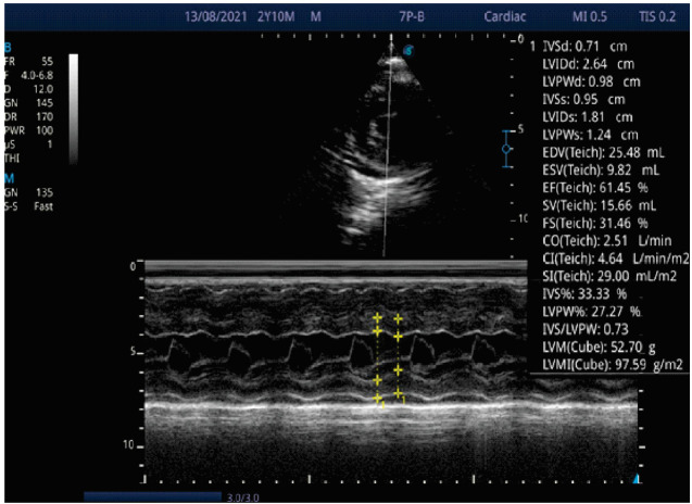 Coarctation of the Aorta Presenting as Haemorrhagic Stroke in a 3-Year-Old Boy- A Case Report.