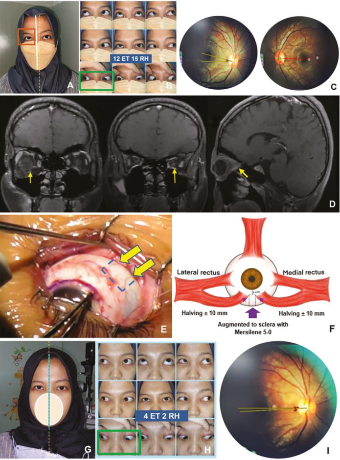 A Promising Outcome of the Augmented Modified Hummelsheim Procedure in a Challenging Case of Inferior Rectus Hypoplasia.