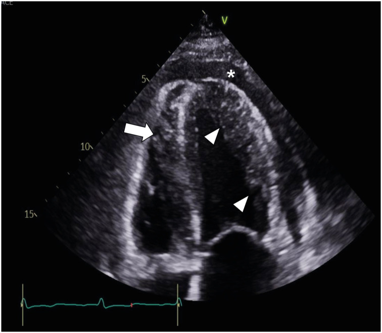 CMR Parametric Mapping Helps Diagnose Diffuse Myocardial Leukemic Infiltration in the Relapse of Acute Lymphoblastic Leukemia.