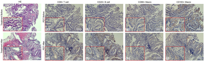 Successful sphincter preservation and long-term survival in a patient with ultra-low locally advanced rectal cancer treated with photodynamic therapy combined with multimodal treatment: a case report and literature review.