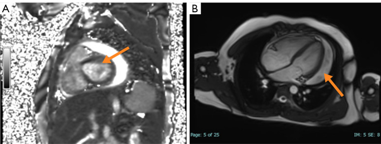 IgG4 elevation dilemma at the crossroads of helminth infection and IgG4-related disease: insights from a case report of pediatric paragonimiasis with persistent pericardial effusion.