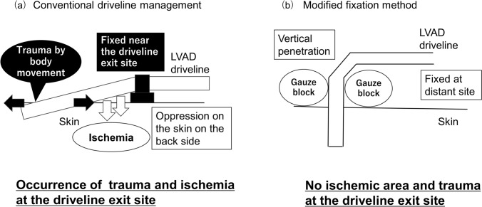 Clinical outcomes of modified left ventricular assist device driveline management.