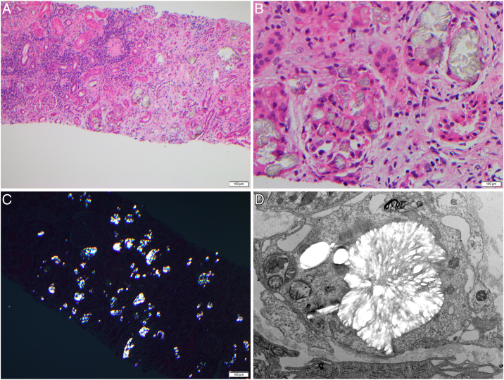 Dietary Oxalate Nephropathy Due to Pureed Feeds.