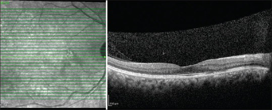 Central serous chorioretinopathy mimicking as choroidal hemangioma - A diagnostic challenge.