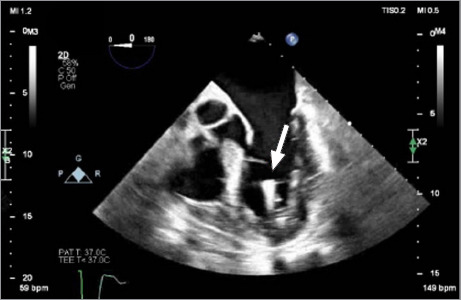 Accidental Left Ventricular Placement of a Leadless Micra Pacemaker Through a Patent Foramen Ovale.