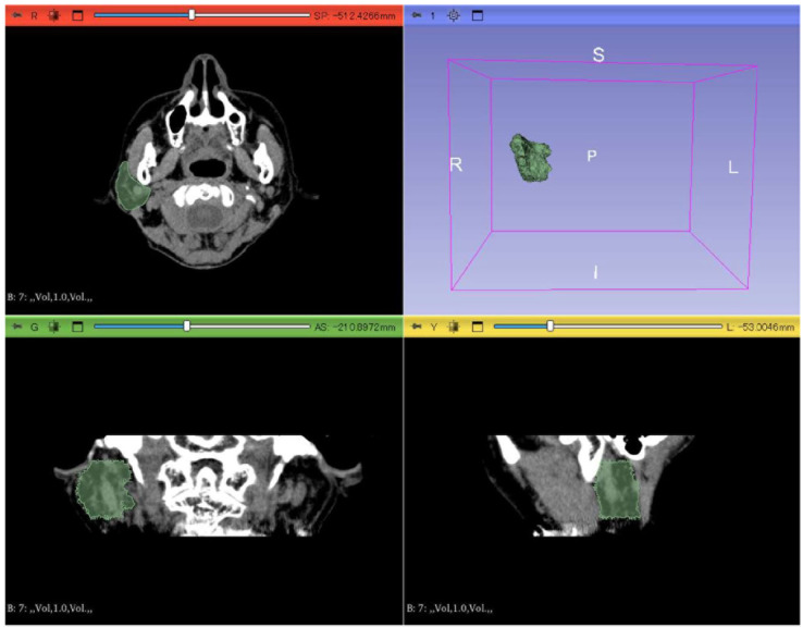 Preliminary approach to creation of a prediction model for diagnosis of Sjögren's syndrome using radiomics and machine learning techniques on computed tomography images of the parotid glands.