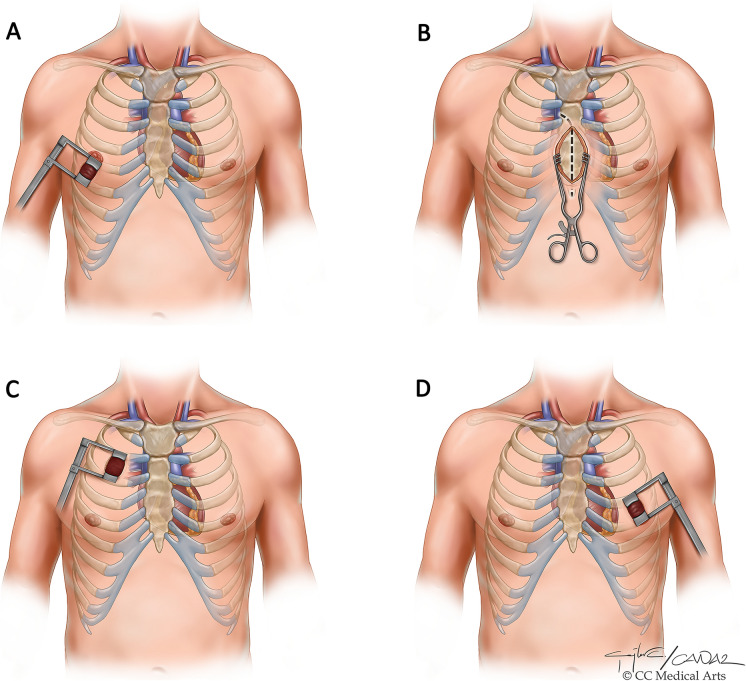 Pain Management in Minimally Invasive Cardiac Surgery: A Review of Current Clinical Evidence.