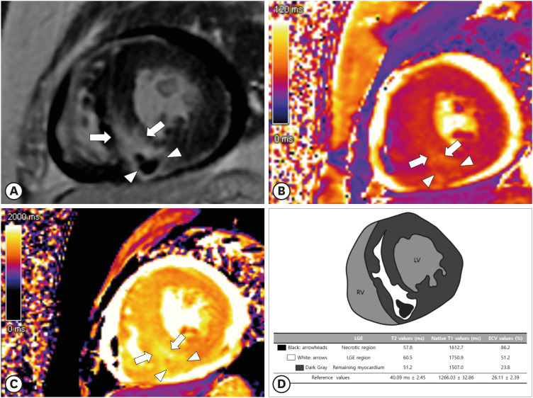 CMR Parametric Mapping Helps Diagnose Diffuse Myocardial Leukemic Infiltration in the Relapse of Acute Lymphoblastic Leukemia.