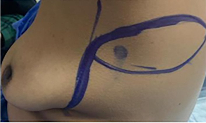Evaluation of Perforator Fasciocutaneous Flaps for Oncoplastic Immediate Reconstruction Following Breast Conservative Surgery in Lower and Lateral Breast Quadrant Lesions Perforator Fasciocutaneous Flaps for OBCS.