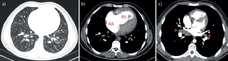 An unprecedented pathology in a 20-year-old with progressive dyspnoea and parenchymal infiltrates.